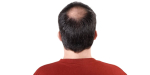 Ketidakbolehan Rambut | Bagaimana Menyelesaikan Masalah Kehilangan Rambut? - Baizigui