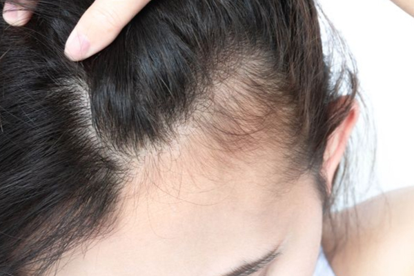 Is Baldness Hereditary? How to Prevent Hair Loss in the Next Generation