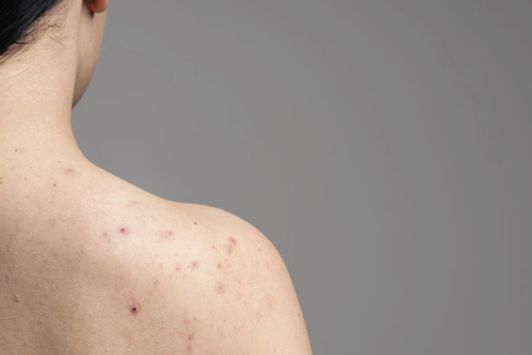 Recurring Skin Sensitivity? Your "Gut-Skin Axis" Might Need a Deep Cleanse