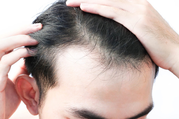 Selamatkan Garis Rambut Anda: Mengapa Kulit Kepala Memerlukan "Detoks Herba"?