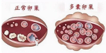 Strategies for PCOS Patients to Achieve Pregnancy