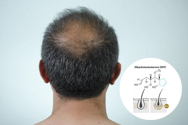 Pemacu Tersembunyi di Sebalik Garisan Rambut yang Semakin Mundur: Hubungan Antara Botak Lelaki dan DHT